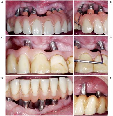 A Mini Review on Non-augmentative Surgical Therapy of Peri-Implantitis—What Is Known and What Are the Future Challenges?